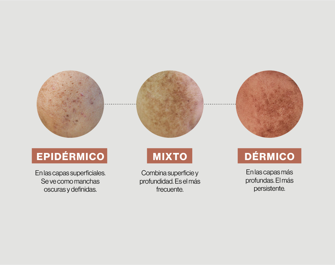 Tipos de melasma, lo que nadie te cuenta