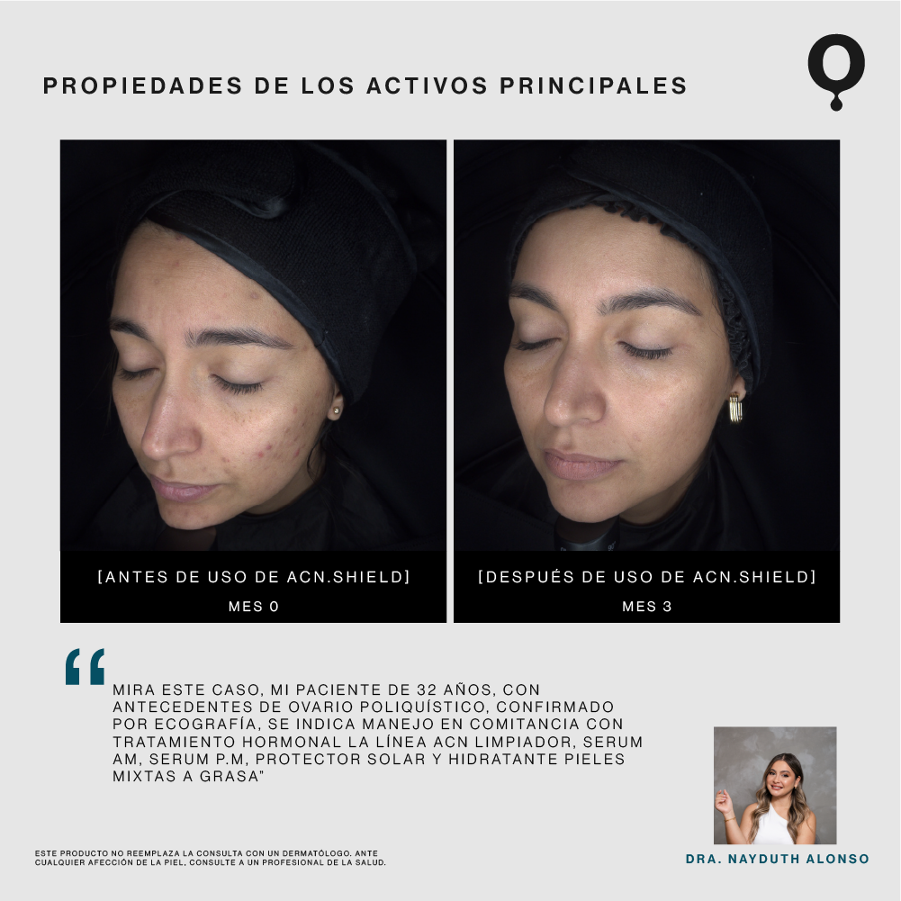 Acn.Shield Serum Corrector y Unificador de Tono