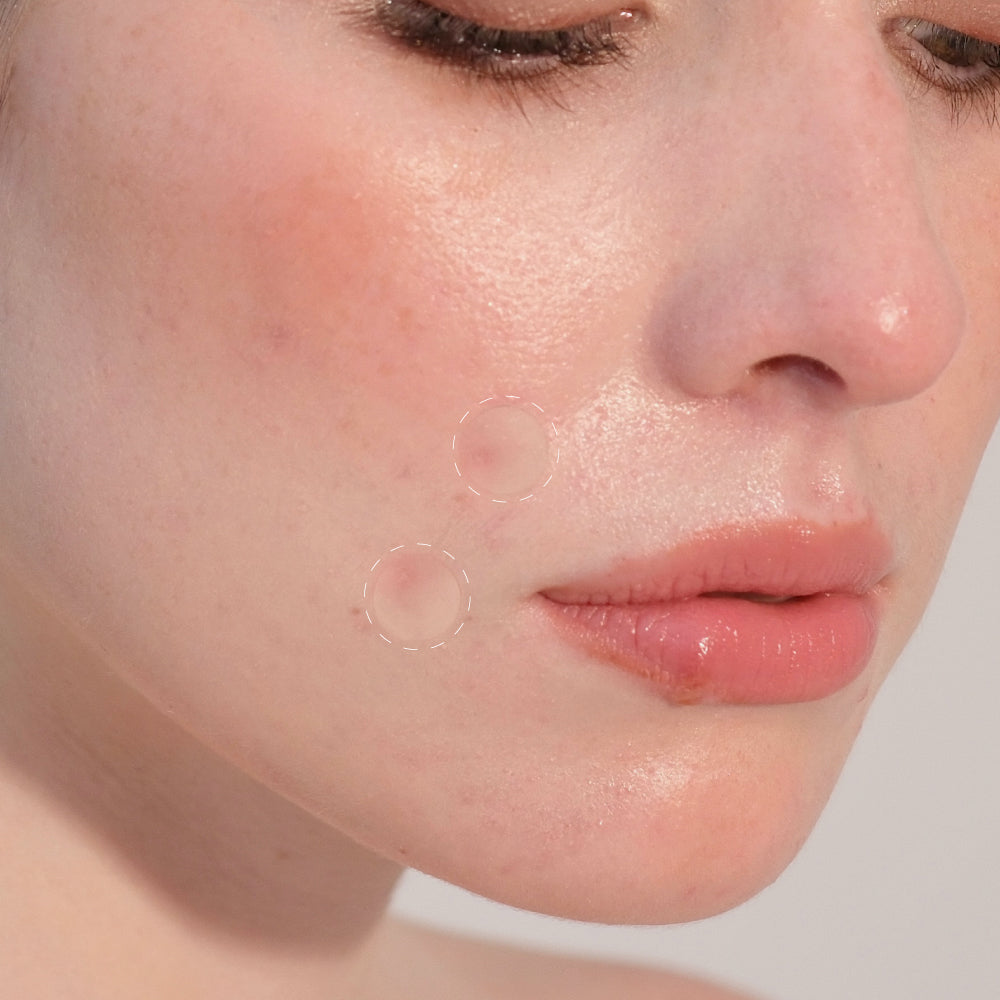 Kit Parches Hidrocoloides para Minimizar Imperfecciones (x2)