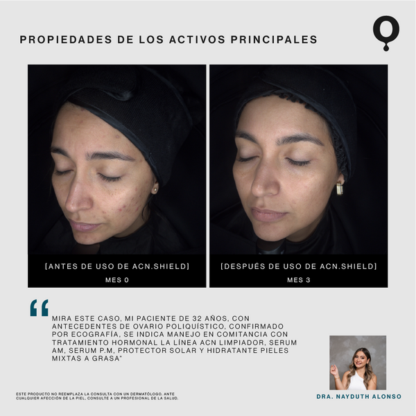 Acn.Shield Serum Corrector y Unificador de Tono