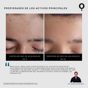 Acn.Shield Limpiador Facial Seborregulador