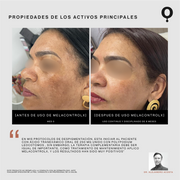 MelaControlX PM Serum Corrector y Restaurador de Tono