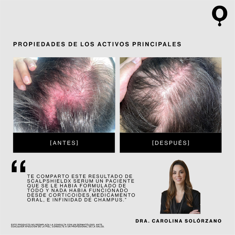 ScalpShieldX: Serum Anticaspa